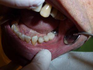 Read more about the article Wkład koronowo-korzeniowy – kluczowy element odbudowy zęba